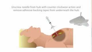 ThoraQuik™ Chest Decompression Device