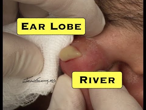 Видео: Pimple On Earlobe: причини, лечение и пиърсинг