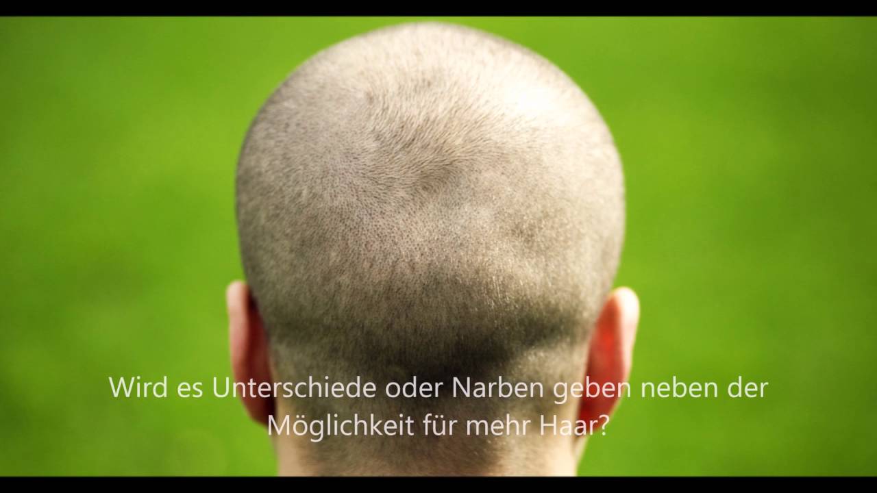 Haartransplantation Techniken Fut Und Fue Was Ist Der Unterschied Vinci Hair Clinic Youtube