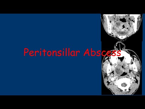 Peritonsillar Abscess