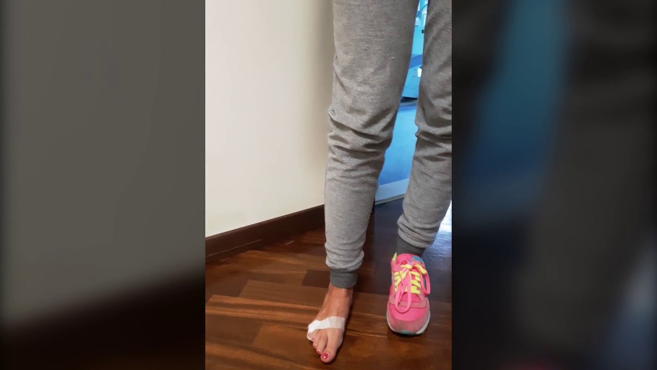 Trattamento precoce delle fratture