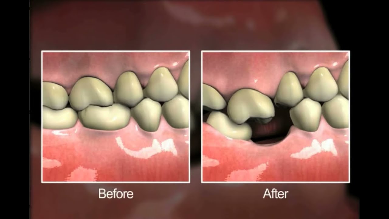 Estrazione Dente Dopo Quanto Posso Mangiare Estrazione Dentale - YouTube