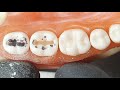 Cavidades dentales según Black #OdontologíadelSigloXXI