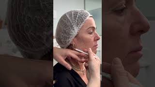 Tratamiento Flacidez Facial Tratamiento Flacidez Facial