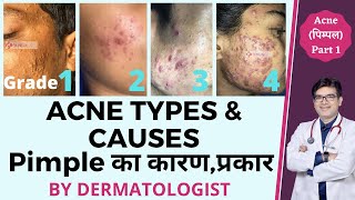 Acne Types and Causes In Hindi | Acne Types with Pictures | Pimple Ke Prakar | Dr Sunil