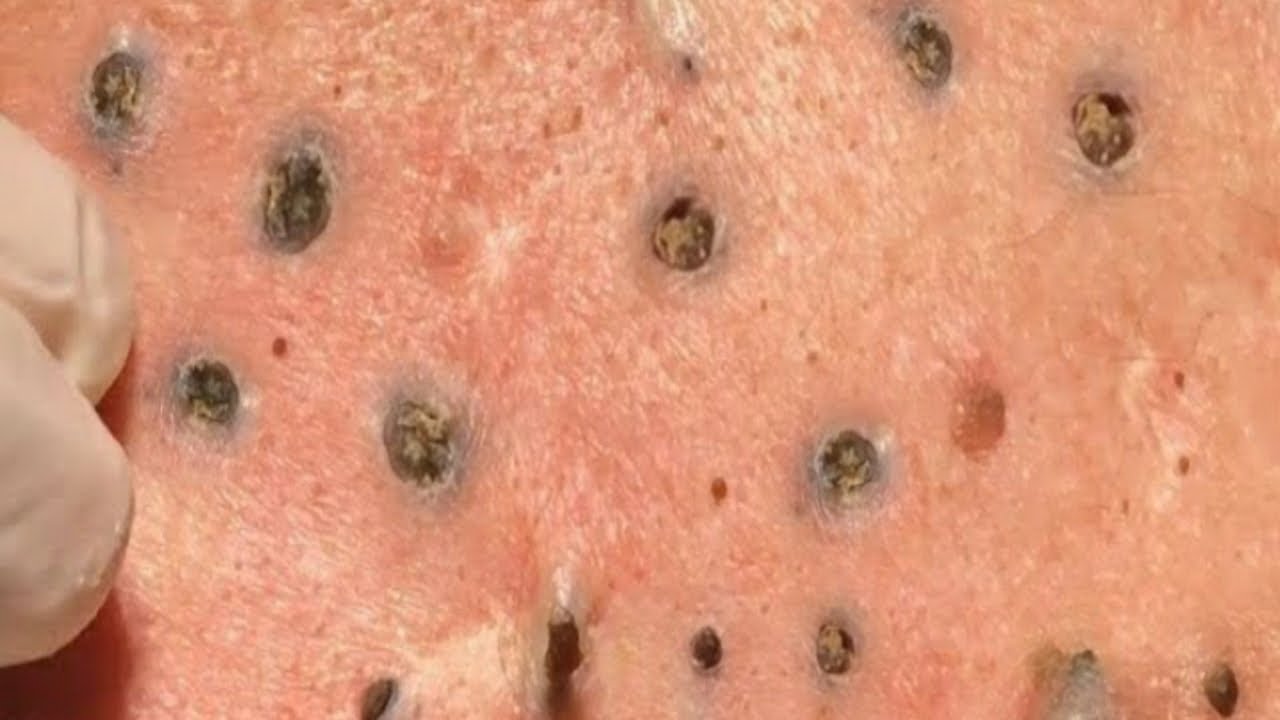 HUGE BLACKHEADS SUCCESSFULLY REMOVED SUFFER FOR HOW MANY YEARS YouTube