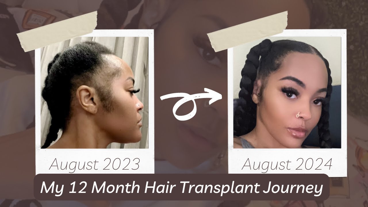 Hair Transplant 12 Month Transformation (Heva Clinic)