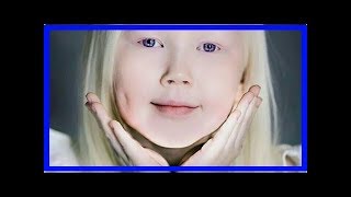 Nariyana, La Niña Albina Que Está Cautivando Al Mundo Por Su Belleza La Llaman Blancanieves