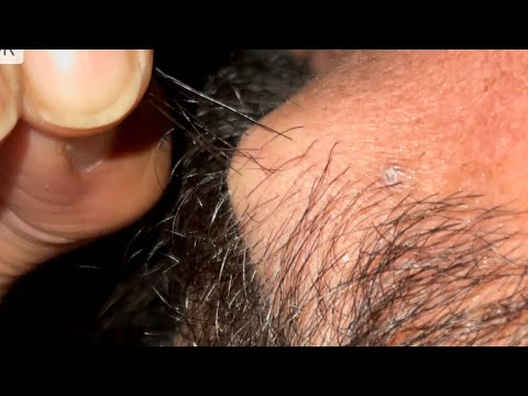 ASMR Beard Satisfying Oddly | Ingrown 10 ingrown
