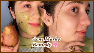 7 days Challenge - Remove Acne scars / Marks - soft and healthy Skin !!! screenshot 1