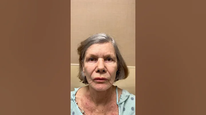 Revision Deep Plane Face and Neck Lift Results #plasticsurgery #facelift #necklift #plasticsurgeon