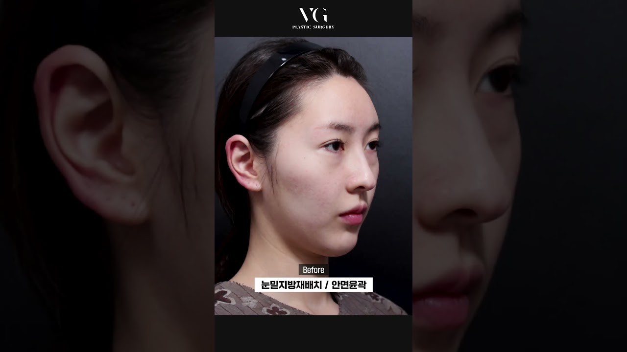 [Вэри Гүүд Гоо Сайхны Мэс Заслын Клиник] #НүүрнийКонтурЗасах #МэсЗаслынСэтгэгдэл Бүдэг нүдний доорх өөхөн уутны байршлыг өөрчлөх, нүүрний контурын Б&А. Үр дүн нь баталгаатай Вэри Гүүд😎