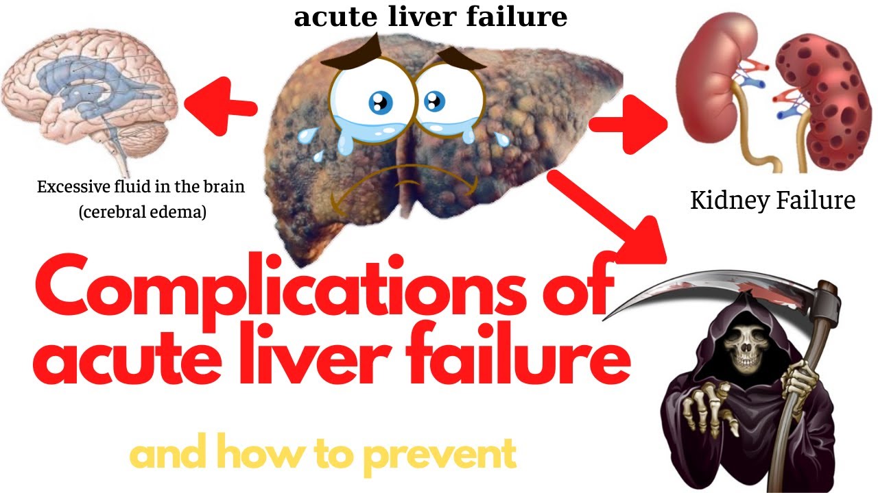Complications and prevention of acute liver failure. What are complications of liver failure? 247nht