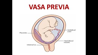 VASA PREVIA