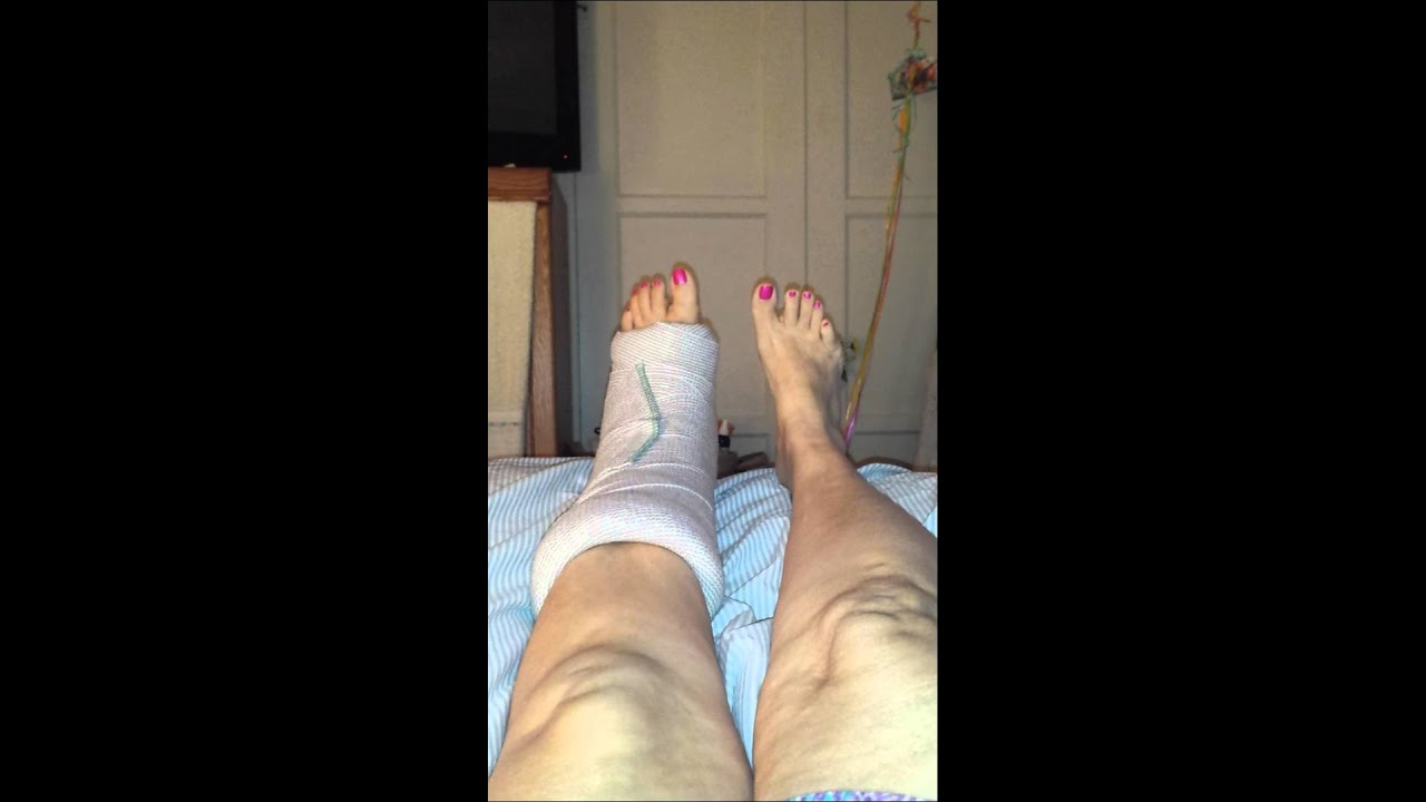 Retrocalcaneal exostosis bursitis, achilles tendon YouTube