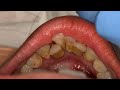 SCALING TARTAR | CALCULUS | KARANG GIGI | Dentist | Dokter Gigi Tri Putra
