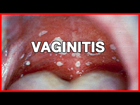 Vaginitis Or Yeast Infection In Women And Men Symptoms, Causes, Natural Remedies And Prevention