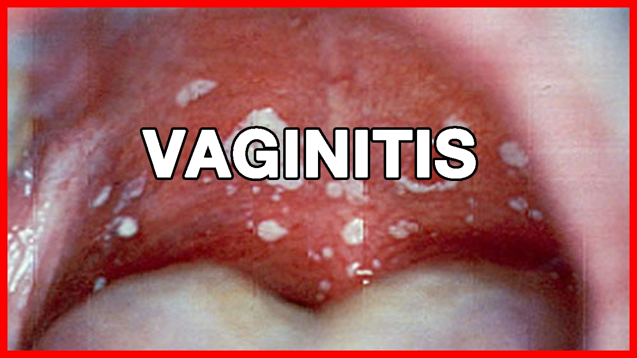 Vaginitis or Yeast Infection in Women and Men Symptoms, Causes, Natural