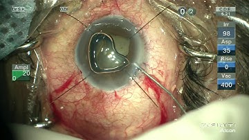 Iris hooks step by step