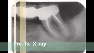 Fantastic Perioscopy Lanap Results Of A Hopeless Tooth