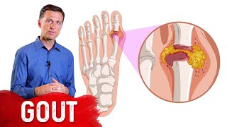 The 7 Natural Remedies for Gout