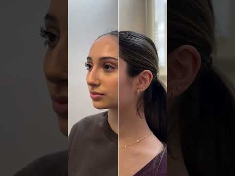 Video thumbnail: Rhinoplasty Transformation | Stunning Nose Results by Dr. Ghersi | Aeris · Aeris