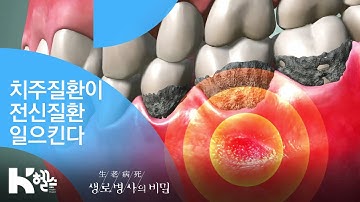 치주질환이 전신질환 일으킨다 - (20181114_670회 방송) 3분의 힘, 잇몸병 개선 프로젝트