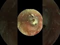 GRIEVOUS Result Of Chronic Cotton Bud Use (Very Satisfying Earwax Removal)🔥