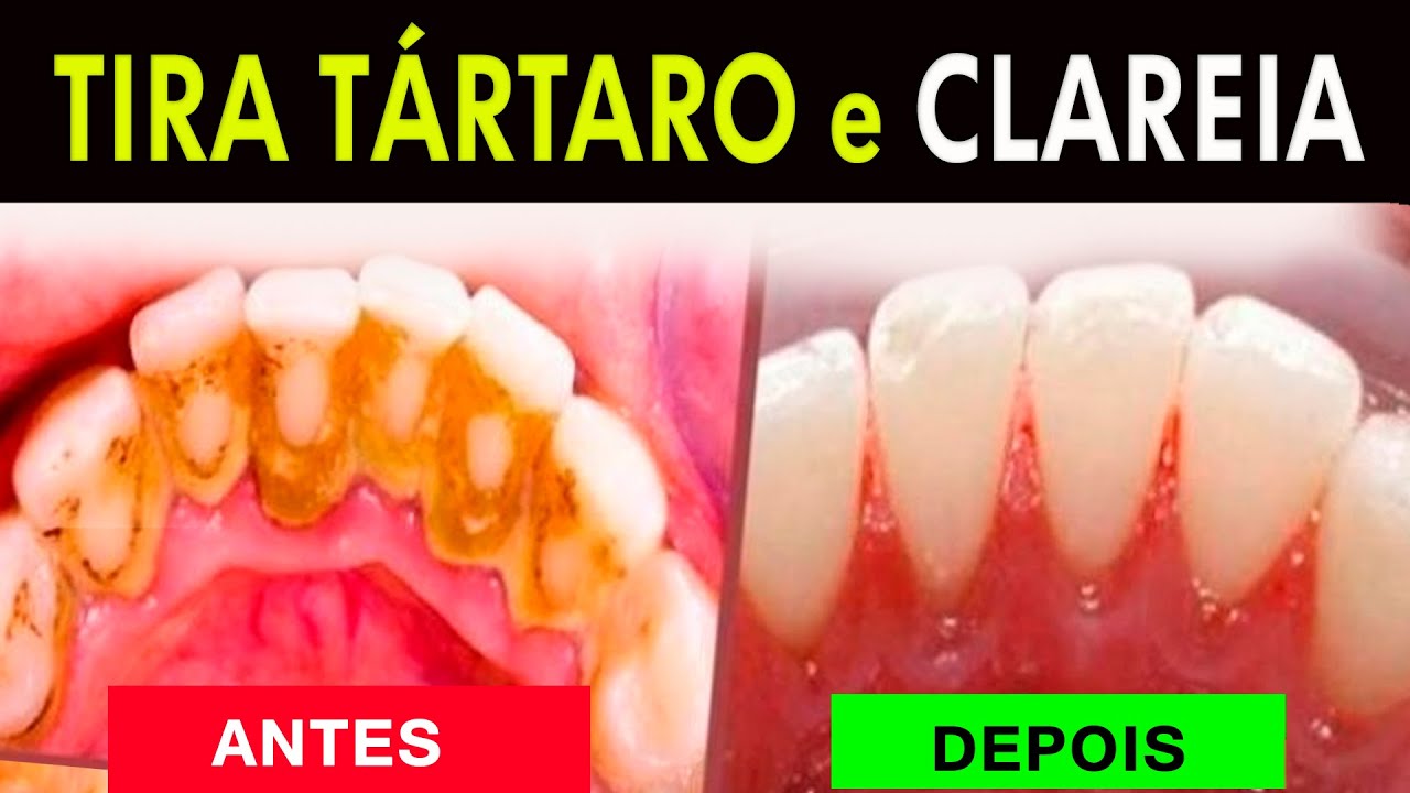 [FÓRMULA MILAGROSA] REMOVE TÁRTARO, CLAREIA OS DENTES, ELIMINA MAU ...