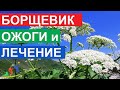 Борщевик Сосновского ожоги и лечение. Первая помощь, если Вы коснулись это ядовитое растение.