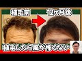 薄毛の時は風が怖かった•••植毛したら毎日快適!!【自毛植毛|薄毛対策】