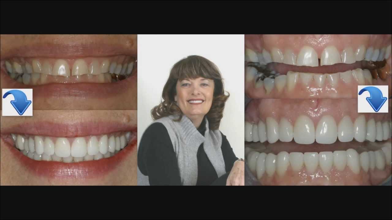 Worn Down Teeth Corrections by Dr. Craig Carlson