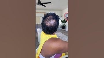 Style my NEW Big Chop with me! Natural TWA Thin Hairloss from PCOS