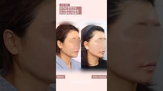 40대 안면거상 수술 후 붓기 변화!! (feat. 초기붓기관리의 중요성)