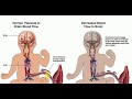 PAEDIATRICS LECTURES , Hypoxic Ischemic Encephalopathy