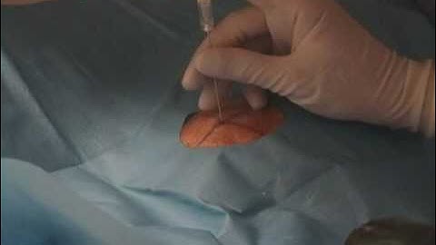 Shoulder and Hip MRI Arthrogram Tutorial (For Medical Personnel and Patients)