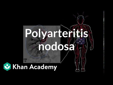 Polyarteritis nodosa | Circulatory System and Disease | NCLEX-RN | Khan Academy