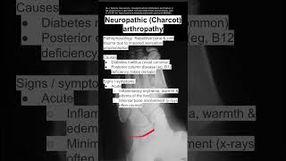 Neuropathic (Charcot) arthropathy