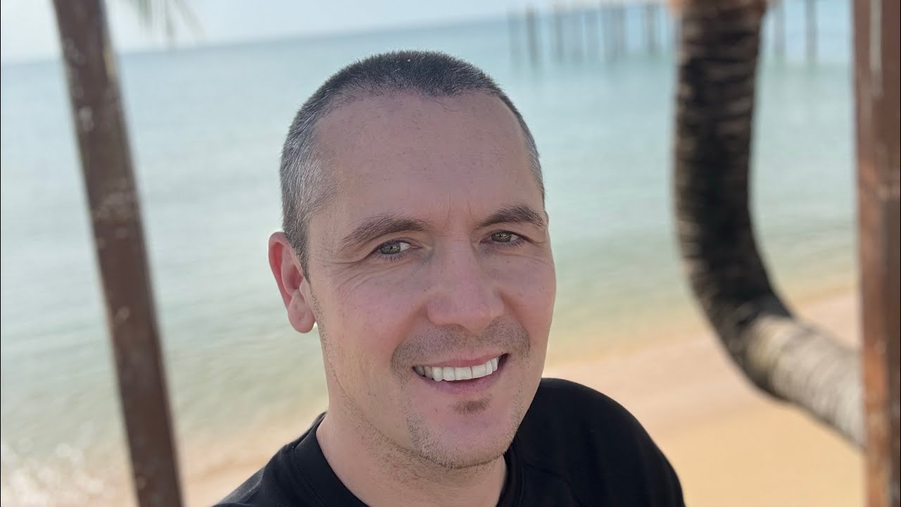 Update hair transplant Cosmedica Clinic - 2 month since operation 