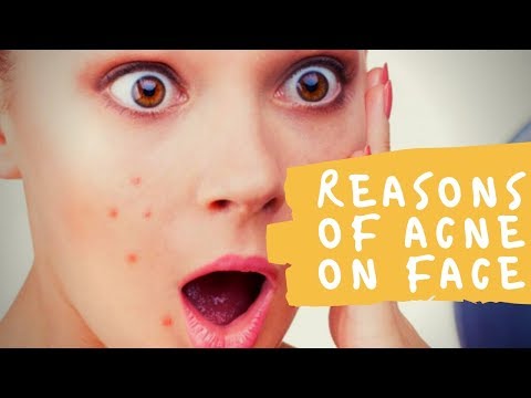 Reasons For Pimples On Face || Reasons Of Acne On Face  || Health Domain 