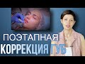 Повторная коррекция губ // Деликатное увеличение губ поэтапно // Делаем естественные красивые  губы!