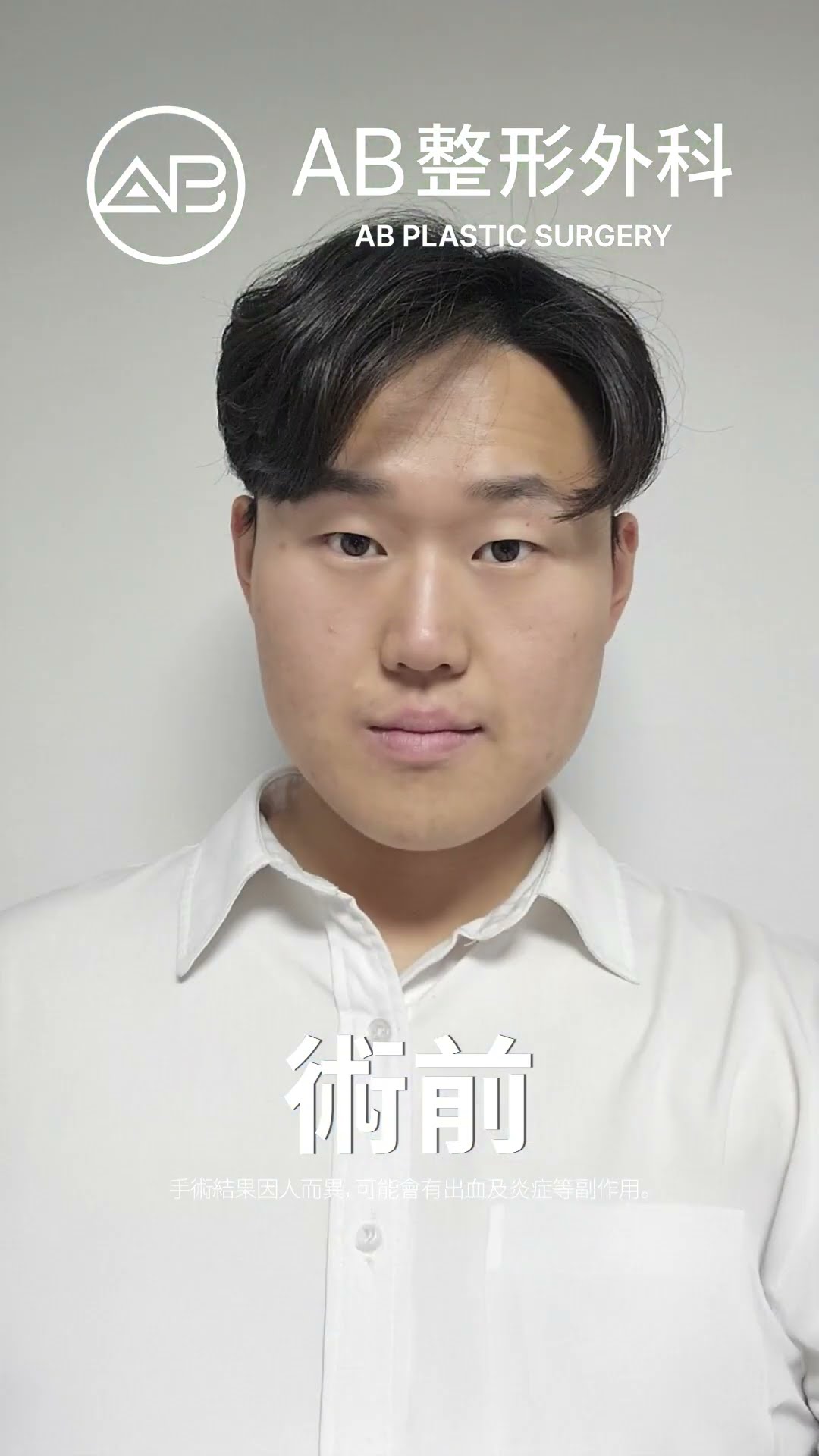從平凡到男神！他的整形故事絕對讓你驚呼！ #热门 #推荐
