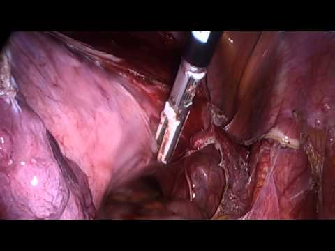 Total Laparoscopic Hysterectomy By Jafaru Abu