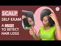 EXAMINE YOUR SCALP! Detect Hair Loss EARLY!