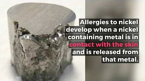 Nickel Allergy Video = Dr. Sandy Skotnicki