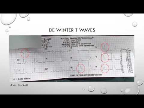 12 Lead ECG Episode 5 - De Winter T Waves