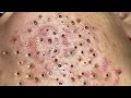 Loan nguyen acne treatment 15366