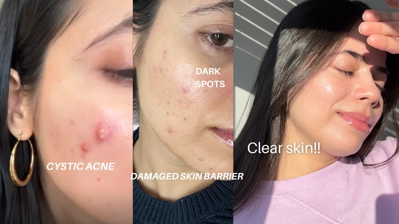 How I cleared my skin after 10 years!(Acne, dark spots & repaired skin ...