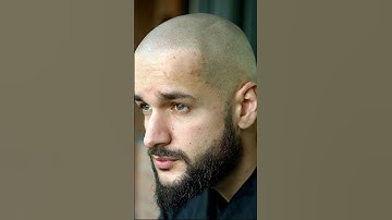 Trước và sau xăm tóc hói #reviewxămtóc  scalpvn