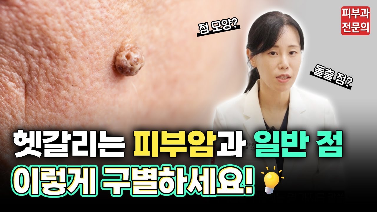 얼굴에 올라온 종양 점인지 암인지 헷갈린다면?! - YouTube